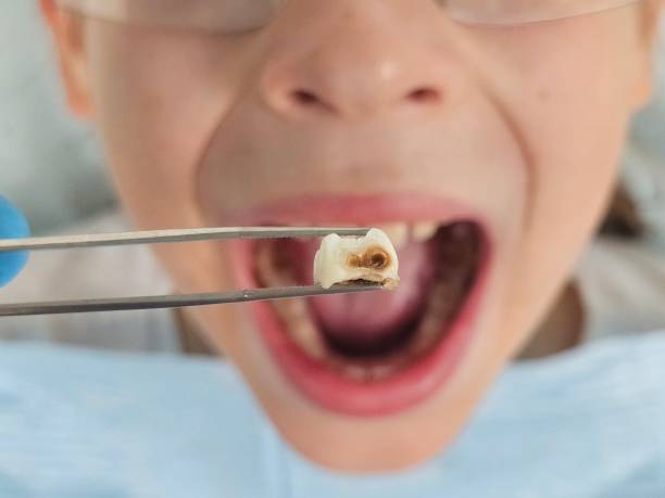 Best Urgent Care for Lost Fillings or Crowns in New York Mills, MN